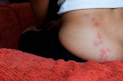 bed-bug-bites-on-back.jpg