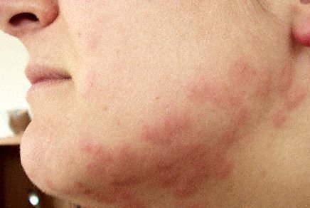 What does bed bug rash look like?