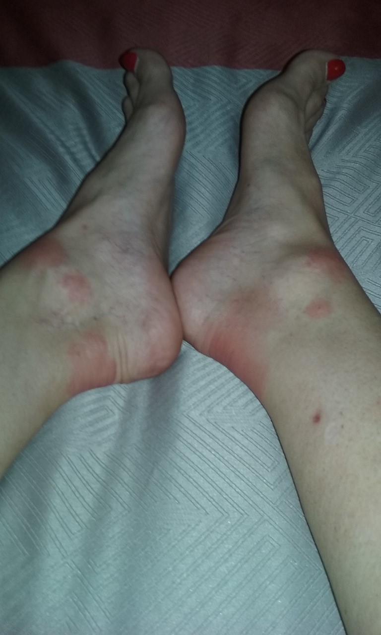bed bug bite rash on legs.