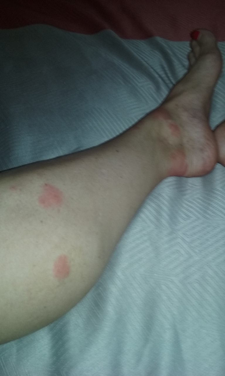 bed bug bite on lower left leg.