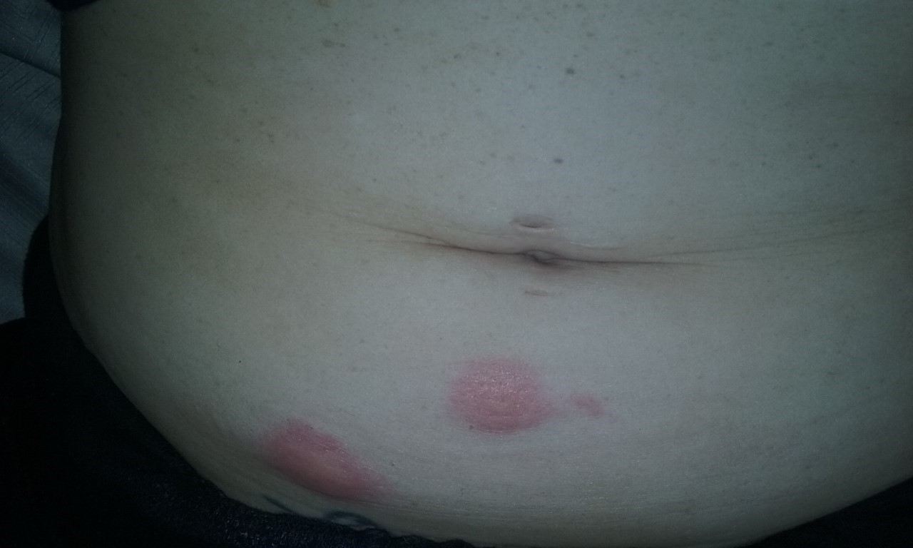 bed bug bite marks on stomache.